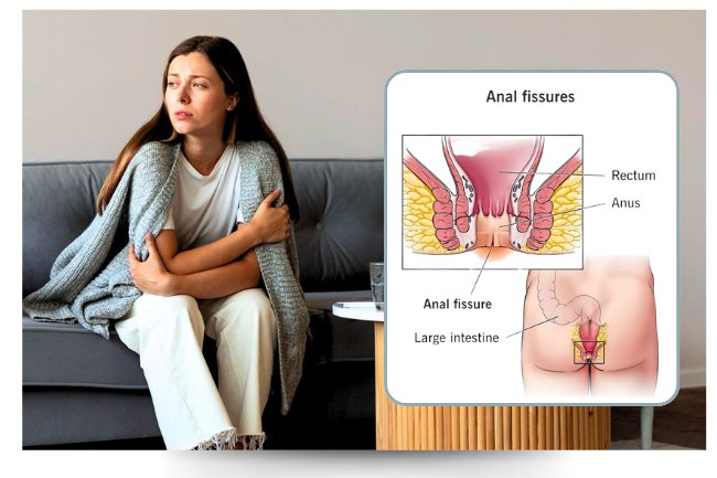 fissure teartment and surgery in Delhi Dr Amita Jain